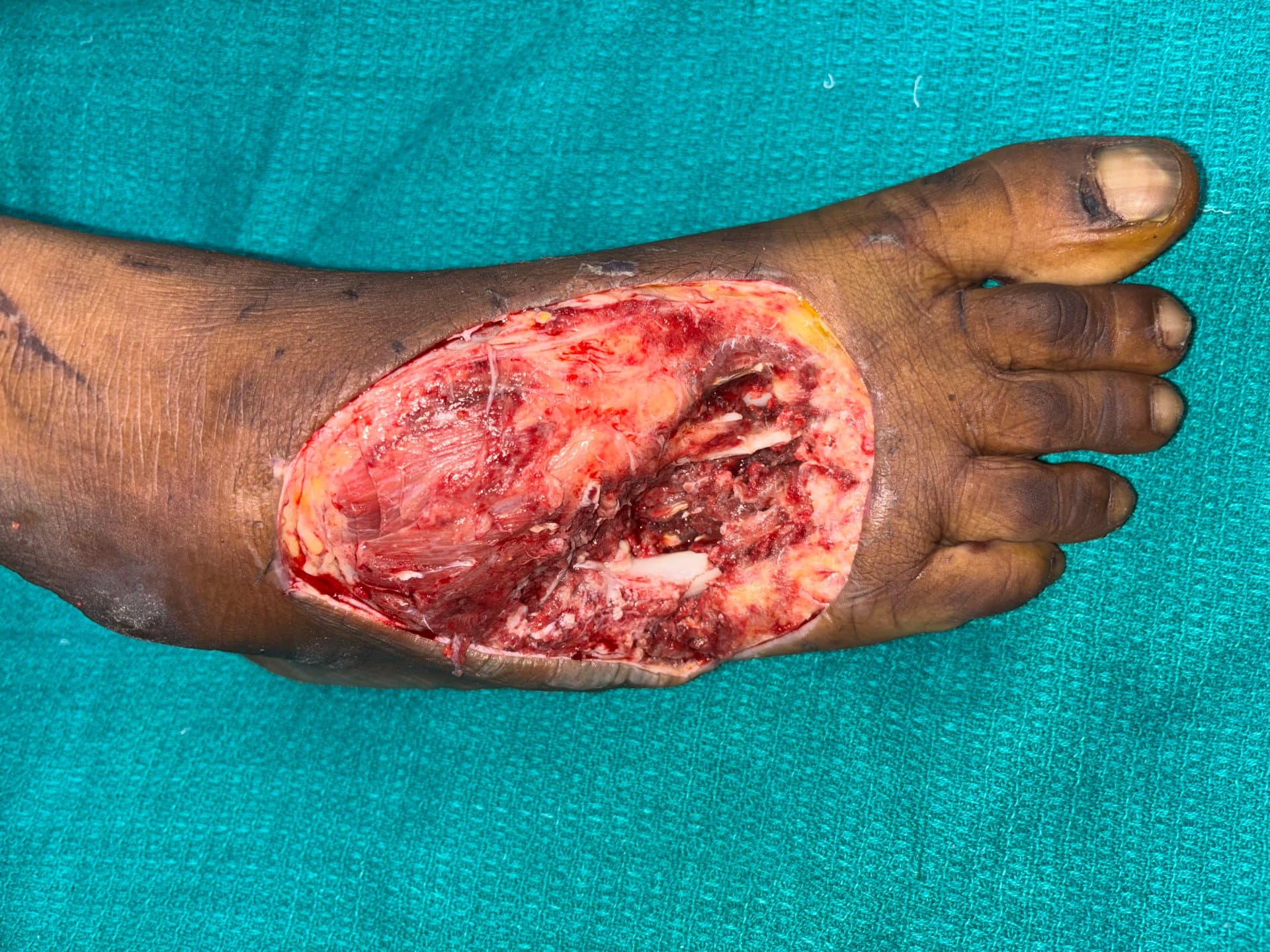 Anterolateral Thigh Free Flap for Gustilo IIIB Open Tibial Fracture with Segmental Soft-Tissue Loss - operative case photograph