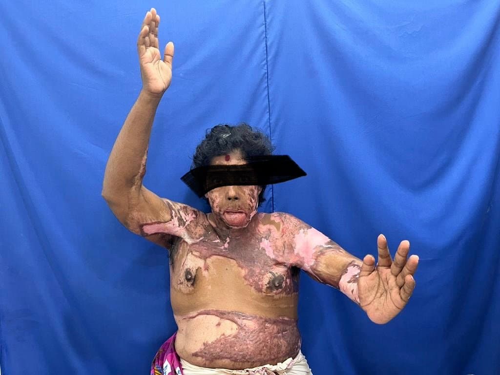 Severe Post-Burn Mentosternal Contracture Release with Meshed STSG - operative case photograph